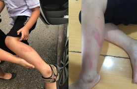 Cô giáo bạt tai, đánh thâm tím chân học sinh lớp 2 trong giờ kiểm tra