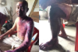 Xót xa người đàn ông bị bỏng nặng, da sắp hoại tử nhưng phó mặc số phận vì không có tiền chữa