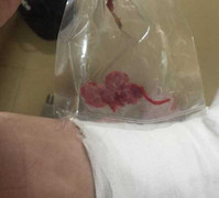 Bệnh nhân tá hỏa thấy bông để quên trong chân sau khi bác sỹ khâu vết thương