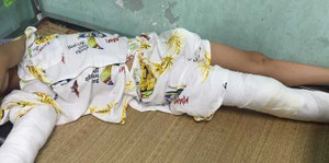 Cứu sống bệnh nhi vỡ sọ sau cú ngã từ độ cao 8m