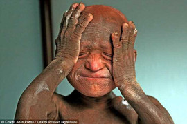 Cậu bé 'hóa đá' vì mắc bệnh da liễu hiếm gặp