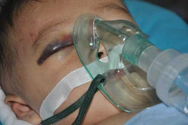 Đau lòng bé 10 tháng tuổi ngã xuống giếng sâu cả chục mét