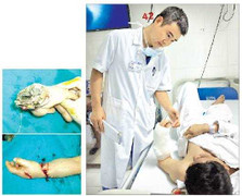Ghép thành công bàn tay bị đứt rời của thợ trộn bê tông