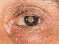 Bài thuốc đơn giản cực tốt cho người đục thuỷ tinh thể