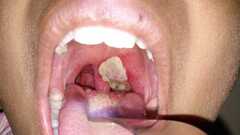 Kết luận về ổ 'bệnh lạ’ khiến 3 người chết ở Bình Phước