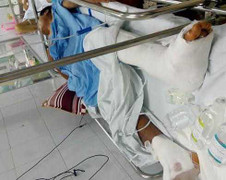 Bệnh viện Việt Đức mổ chân trái lộn sang chân phải: Bác sỹ nhận lỗi vì không xem bệnh án