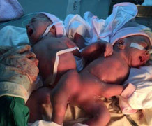 Xót thương hai bé gái song sinh dính liền mông, không có hậu môn