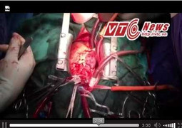 4 ca ghép tạng một đêm: Tim, gan không 'vừa' người nhận, giáo sư 'bàn tay vàng' xử lý thế nào?