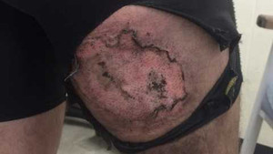 Bất ngờ iPhone 6 bốc cháy, 'nướng' cháy cả mảng da đùi