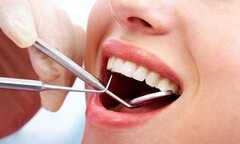Thực hư việc lấy cao răng làm răng yếu đi