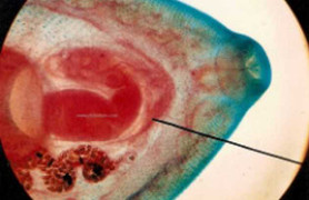 Sững sờ chứng kiến 'khối u di căn' biến mất khỏi cơ thể người phụ nữ U50