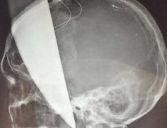 Bệnh viện Việt Đức phẫu thuật lấy dao bầu cắm xuyên não bệnh nhân