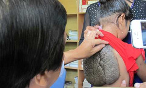 Bé gái mang khối u hình mai rùa ở lưng chưa từng thấy ở Việt Nam