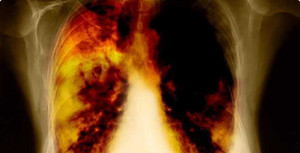 Tầm soát ung thư giúp phát hiện sớm nguy cơ mắc bệnh