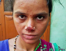 Chồng cắt bay mũi vợ vì không có của hồi môn