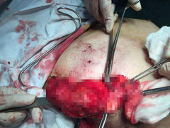 Bơm silicon dạo, người phụ nữ phải cắt bỏ toàn bộ tuyến vú