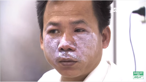 Cách xử trí vết viêm da do tiếp xúc với kiến ba khoang