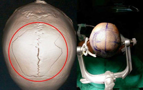 Hy hữu: Đầu đụng trần nhà, 2 ngày mới biết bị nứt sọ não