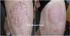 Nghiên cứu mở trung tâm về sản phẩm Dr Michaels® thảo dược trong điều trị bệnh vảy nến