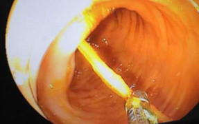 Bé trai 14 tuổi nuốt phải tăm nhọn bị đâm xuyên thành ruột