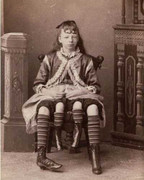 Hội chứng hiếm gặp: Người đàn bà 4 chân khiến y học chưa thể lý giải