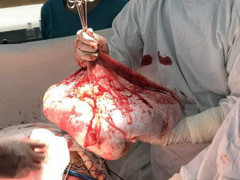 Cứu bệnh nhân có khối u buồng trứng nặng 35kg trong bụng