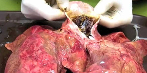 Bao nhiêu người còn dám hút thuốc sau khi xem video này?