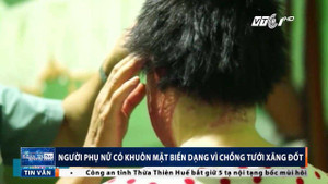 Xót xa cô gái xinh đẹp bị chồng tưới xăng đốt, biến dạng gương mặt