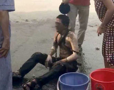 Nổ trạm biến áp: Cách sơ cứu ai cũng nên biết