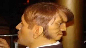 Bí ẩn về những người đàn ông hai mặt khiến y học bối rối