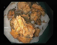 Bệnh nhân bị 4 khối bã thức ăn to như quả trứng trong dạ dày vì ăn loại quả quen thuộc này