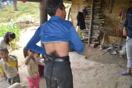 Chuyện lạ: Người mọc đuôi ở Hà Giang