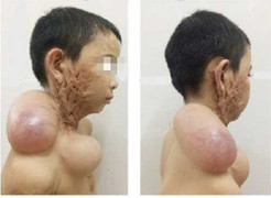 Ly kỳ điều trị sẹo lồi khổng lồ vùng hàm mặt sau bỏng cồn cho bé 9 tuổi