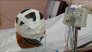 Bệnh động kinh ở trẻ em gia tăng báo động