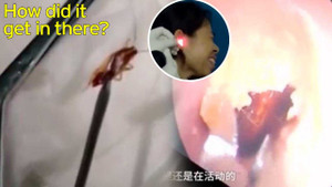 Gián chui vào tai người lúc ngủ, vẫn sống 'ngọ nguậy' khi bị gắp ra