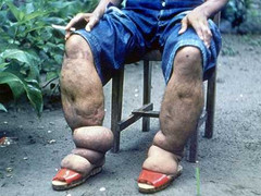 Bệnh quái ác: Con vật nhỏ như sợi chỉ khiến tinh hoàn phì đại khổng lồ