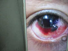 'Dzô' quá sung, ly bia vỡ bắn thủng mống mắt