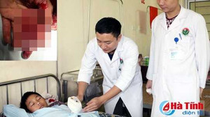 Tự chế pháo nổ, nam sinh lớp 7 phải tháo ngón tay giữa