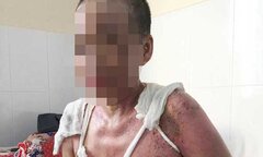 Từ chối móc cống, nhân viên quán cơm bị tạt cả nồi thịt sôi vào người
