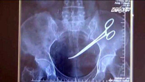 Vì sao kéo nằm trong ổ bụng 18 năm mà bệnh nhân không biết?