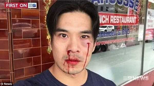 Diễn viên 'Truy sát' bị đánh chảy máu mũi, mẻ răng ở Sydney