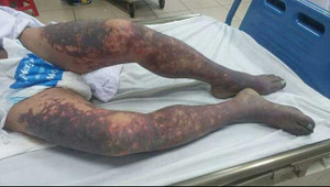 Ăn tiết canh 'lợn cắp nách', bị ban hoại tử toàn thân