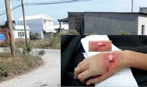 Chạy xe máy nẹt pô inh ỏi, nam thanh niên bị chém đứt gân tay