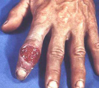 Có thể chữa khỏi bệnh giang mai?