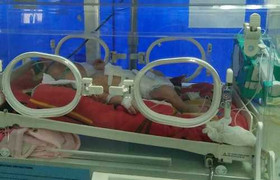 Bé sơ sinh bị thủng ruột từ trong bụng mẹ