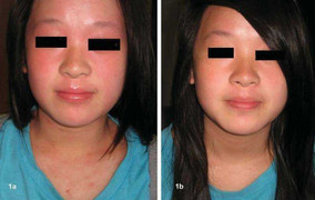 Điều trị viêm da dị ứng ở trẻ em bằng phương pháp Dr Michaels thảo dược