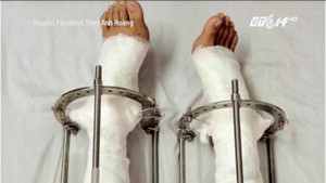 5 năm chịu đau đớn kéo dài chân, chàng trai Hà Nội cao thêm 10cm