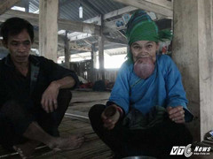 Bà cụ ở Hà Giang có chiếc lưỡi khổng lồ: Cần khẩn trương đưa đi khám