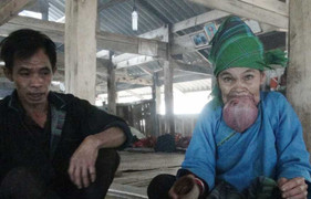 Xót xa nhìn cụ bà ở Hà Giang khổ sở vì chiếc lưỡi khổng lồ