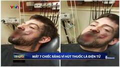Thuốc lá điện tử phát nổ trong miệng, người đàn ông mất 7 cái răng, bỏng nặng